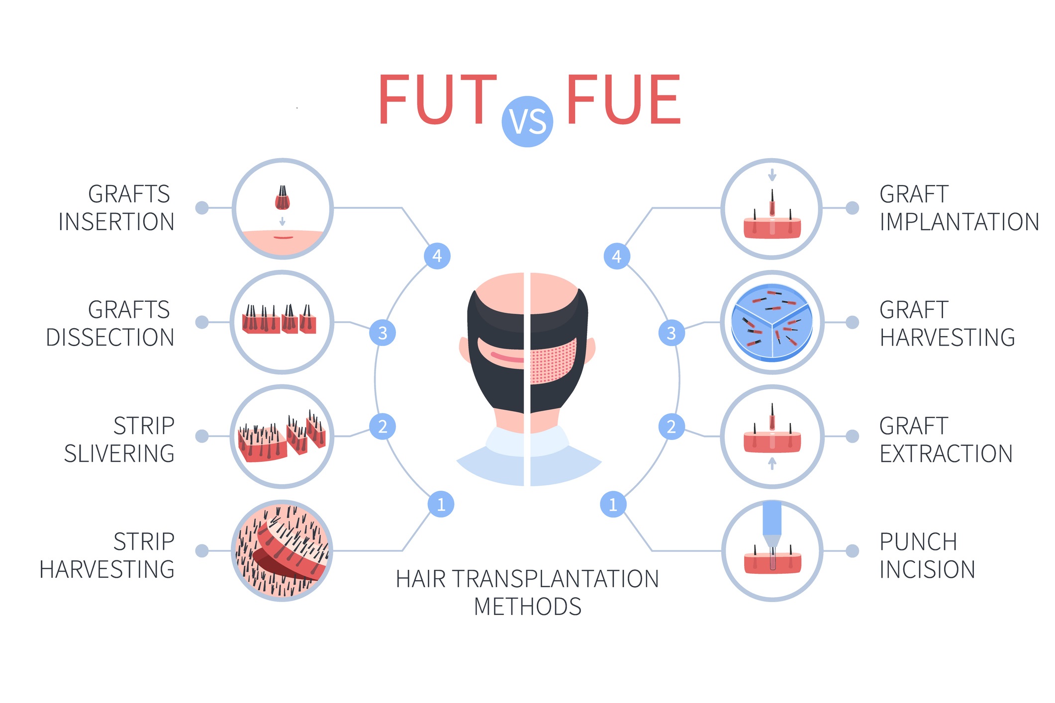 Hair Transplantation Methods