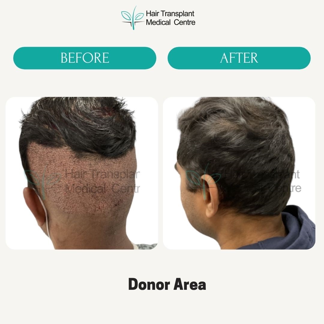 Hair Transplant Medical Center | Hair Loss Clinic in the GTA & Mississauga  | FUE & FUT Hair Regrowth & Replacement Systems