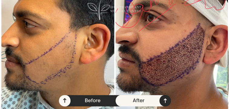 Beard Transplant before after