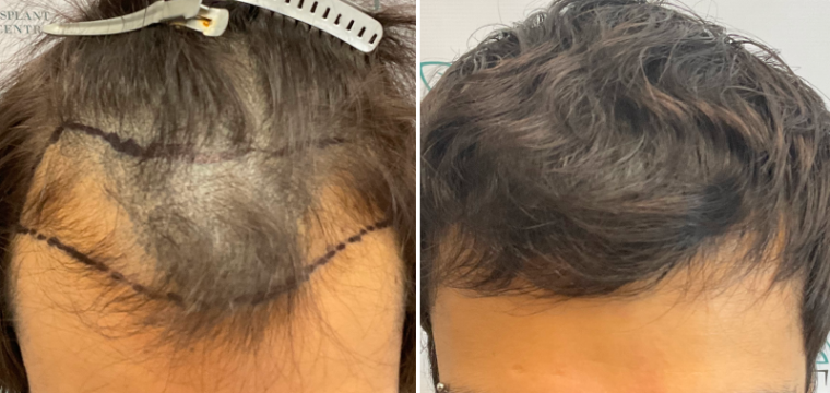 hair transplant before after