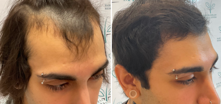 hair transplant before after