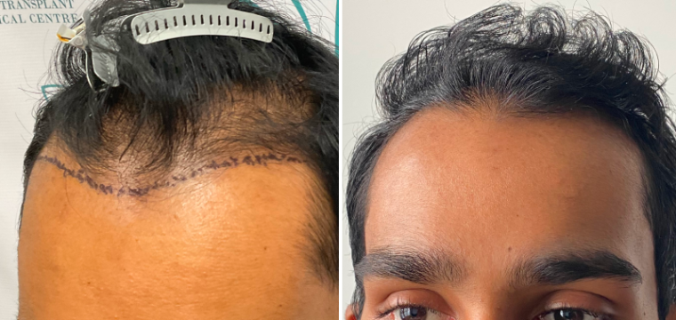 hair transplant before after