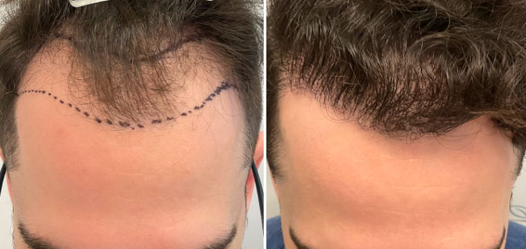 hair transplant before after