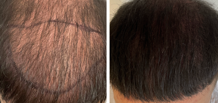 hair transplant before after