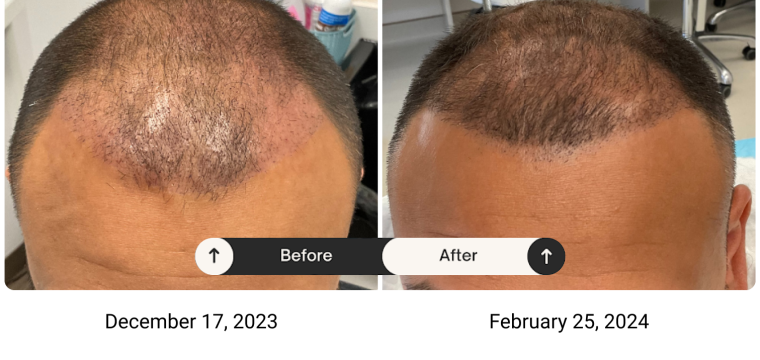 Growth Factor Therapy & Low Level Laser Therapy before after