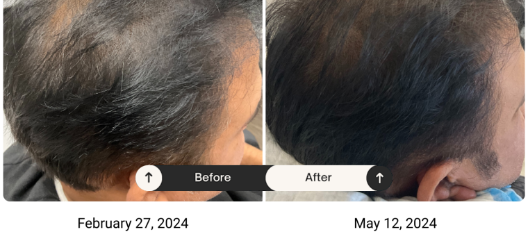 Growth Factor Therapy & Low Level Laser Therapy before after