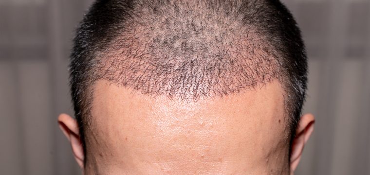 NeoGraft Hair Transplantation | Benefits of Neo Graft | FUE Hair Transplant Surgery | Hair Transplant Clinic Canada