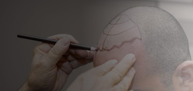 Male Hair Transplant Surgery | Follicular Unit Extraction | Follicular Unit Transplantation | Best Hair Transplant Clinic Canada
