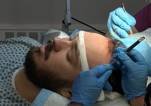 Hair Transplant in Toronto